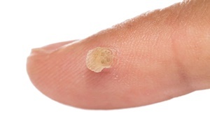 Bradavicu je kožne bolesti koji praktično bori Skincell Pro